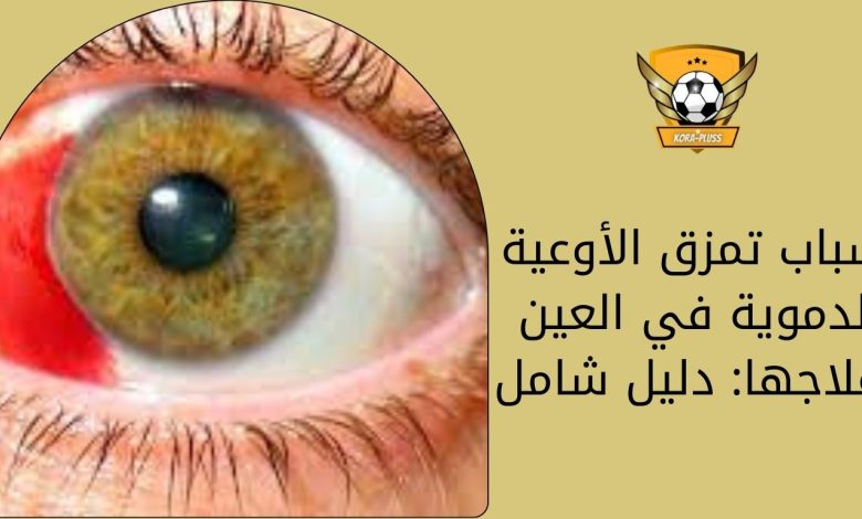 أسباب تمزق الأوعية الدموية في العين وعلاجها: دليل شامل